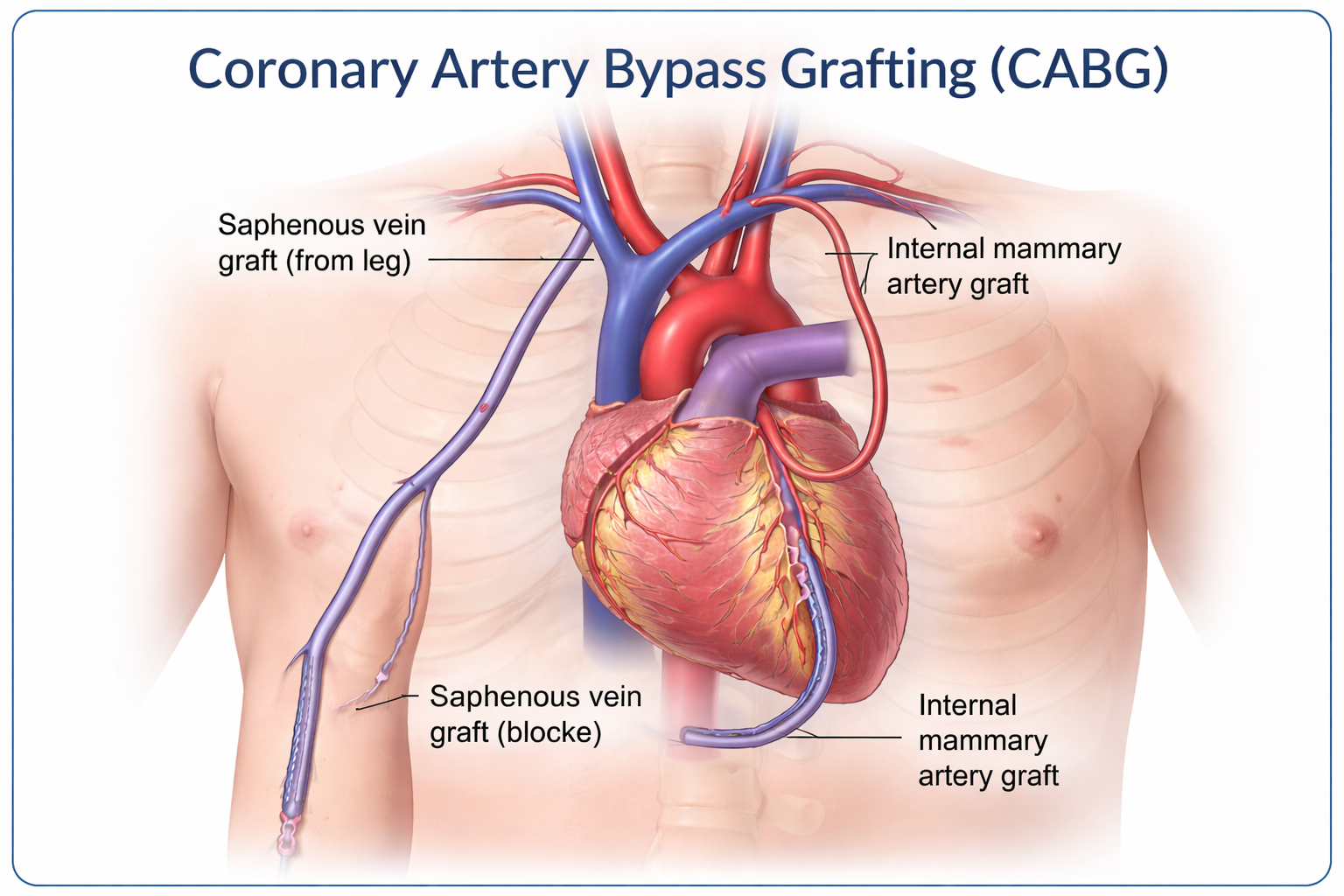 what is bypass surgery diagram showing coronary artery bypass grafting CABG