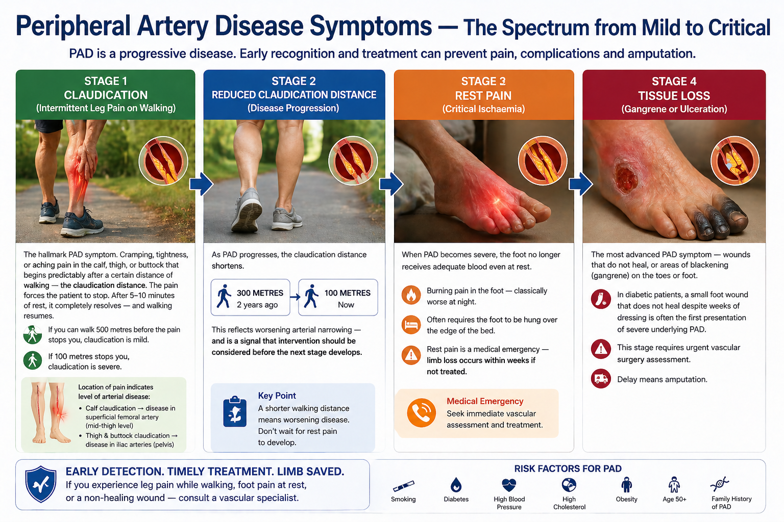   peripheral artery disease symptoms
