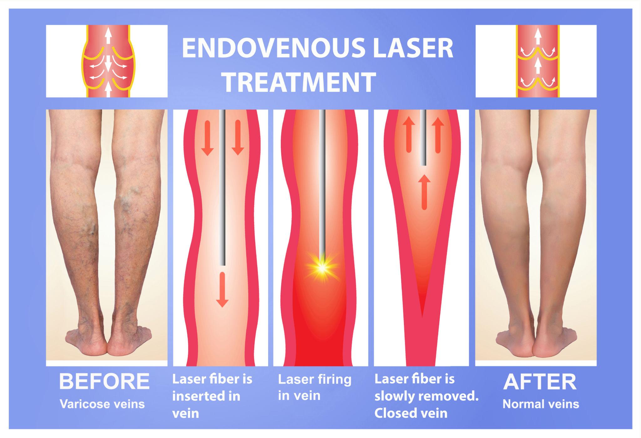 EVLT Laser Treatment for Varicose Veins — What to Expect Before, During and After