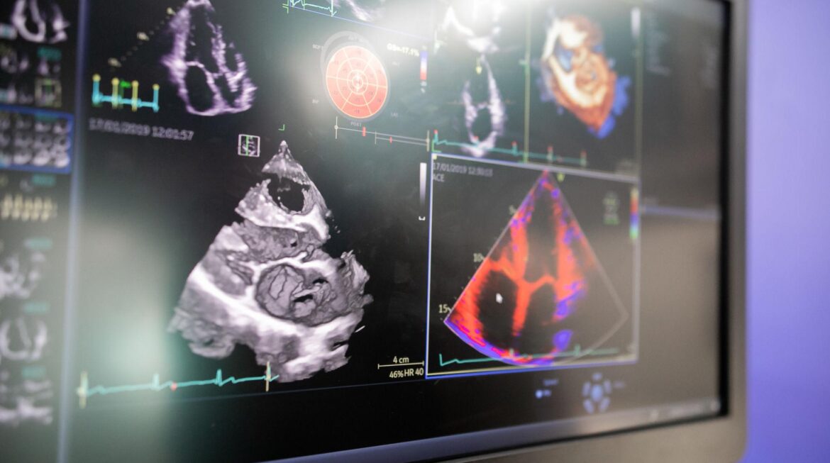 What Is an Echocardiogram? What It Shows and Why Your Doctor Ordered It