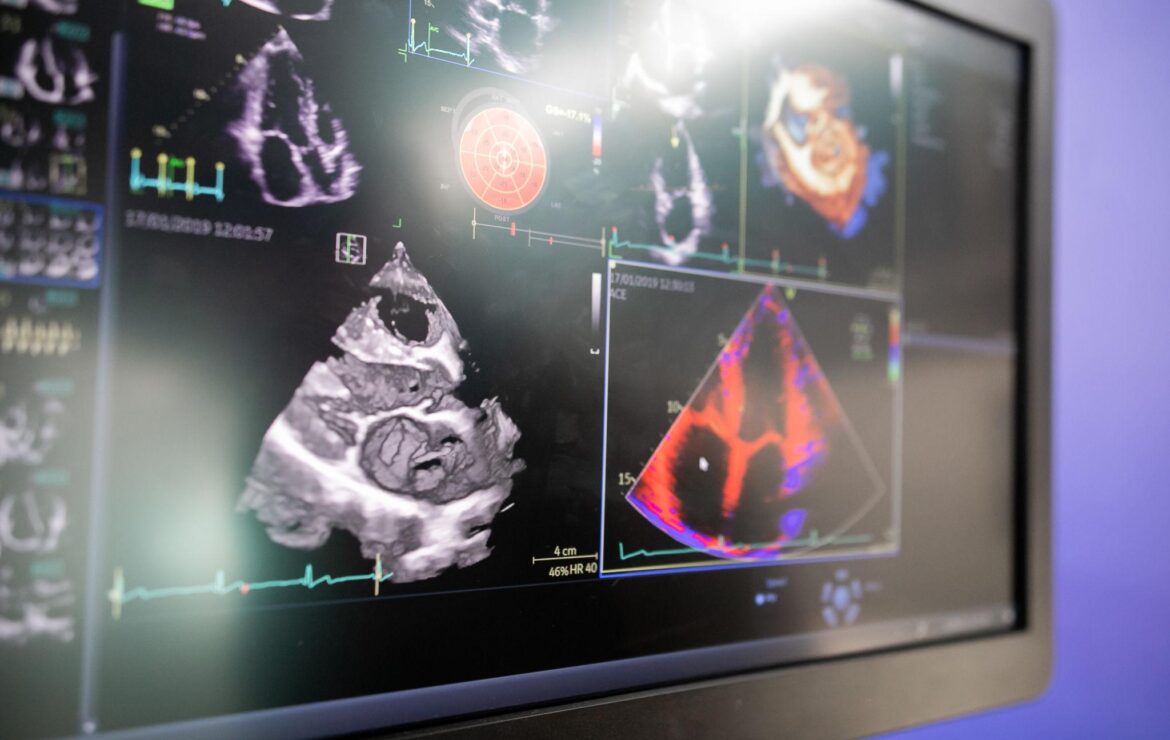 What Is an Echocardiogram? What It Shows and Why Your Doctor Ordered It